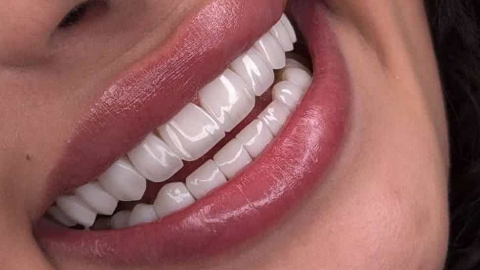 بهترین دکتر دندانپزشک خدمات کامپوزیت در تهران