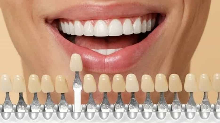 اصلاح طرح لبخند با لمینت و کامپوزیت در تهران